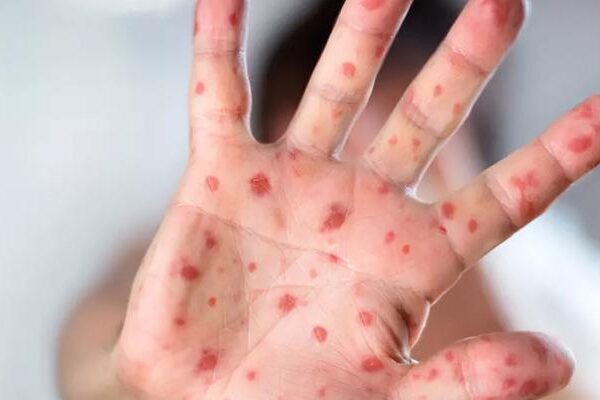 Morbillo, 27 yıl sonra en fazla vaka! Avrupa için Alarm … DSÖ: “Geri”