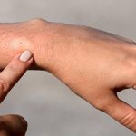 Arıların sokmalarına bağlı alerjik reaksiyonlar ölüme neden olabilir