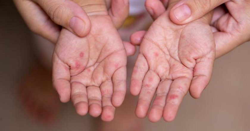Manuel ayak hastalığının belirtileri nelerdir? El ayak hastalığı nasıl anlaşılır? Tedavi yöntemleri nelerdir?