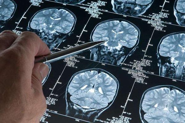 Erkeklerde gizlenmiş tehlike! Alzheimer araştırmasında, genetik varyantın demans riskini arttırdığı keşfedildi: bu varyantlı erkeklerde gelişme riskinin 2.39