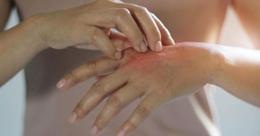 Egzama nedir? Egzama belirtileri, nedenleri ve etkili tedavi yöntemleri