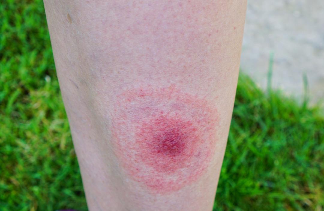 Keneler Tehlike: Lyme hastalığa neden olur: bu semptomlara dikkat! Uzmanlar uyarıyor: 