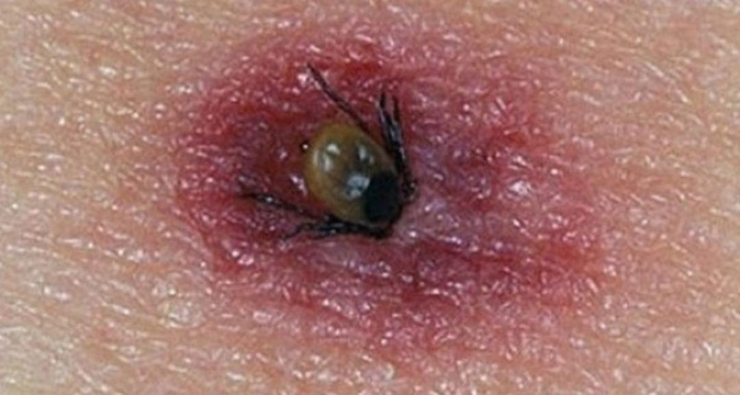 Keneler Tehlike: Lyme hastalığa neden olur: bu semptomlara dikkat! Uzmanlar uyarıyor: 