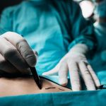 Liposuction nedir, nasıl yapılır? Liposuction tedavisi hangi durumlarda?