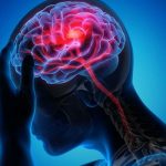 İnme Nöroloğundan Uyarı: ‘Erken Müdahale İnmeyi Önler’