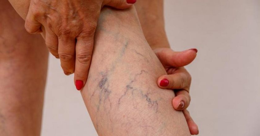 Varikosel nedir ve semptomları nedir? Varikosel nasıl işlenir?