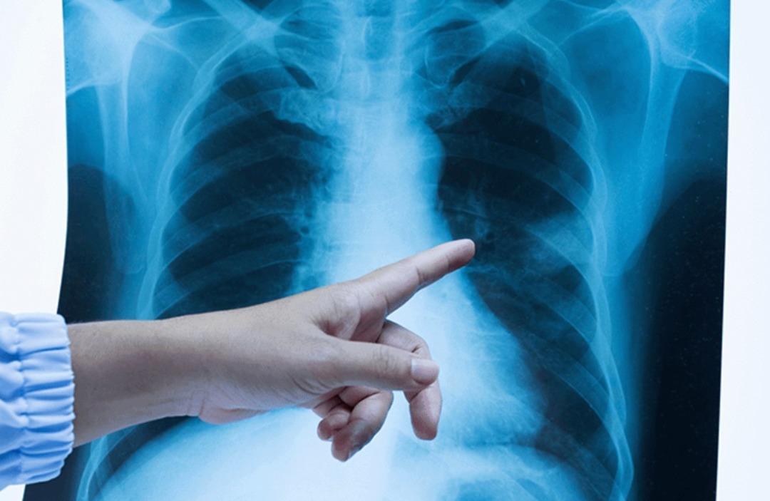 En sık ölüme neden olan tür: akciğer kanseri! %90'ın sebebinin ne olduğunu öğrenin... 2