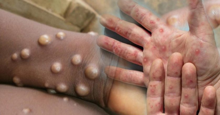 DSÖ M-pox Virüsü Uyarısı: Salgın kıtayı aştı! “Kontrol altında olmalı”