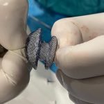 Çarpıntı, nefes darlığı ve yorgunluk şikayetiniz varsa dikkatli olun! Kalp deliği artık kapalı yöntemle tedavi edilebilecek