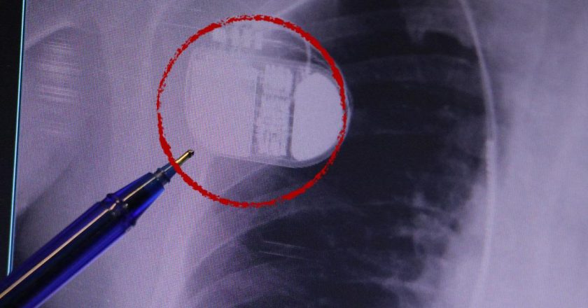 Kalp pili taşıyanlar dikkat! Soğuk Uyarısı: “Üşüme Cihazınızı Aldatabilir” Sağlık Haberleri