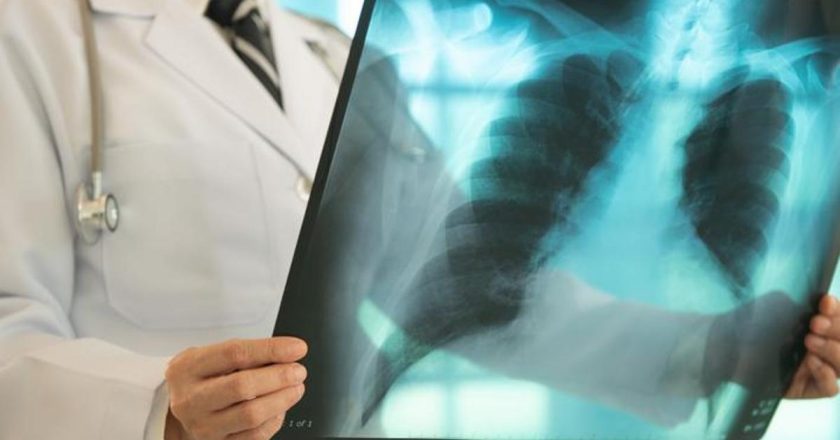 Erken teşhis önemli! Akciğer kanserinin belirtileri nelerdir? Öksürük, göğüs ağrısı, halsizlik, balgamda kan… –